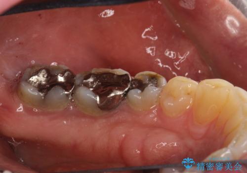 歯石除去 PMTCの治療前