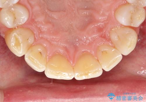 歯石除去 PMTCの治療後