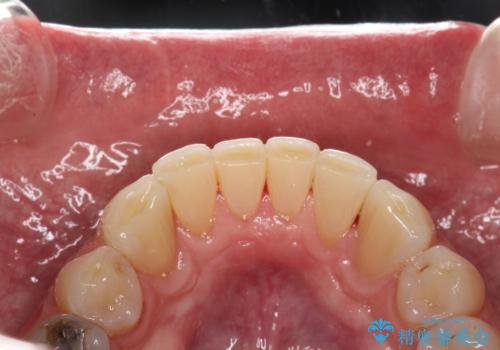 歯石除去 PMTCの治療後