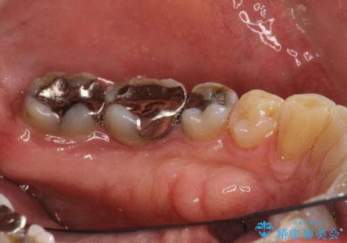 歯石除去 PMTCの治療後