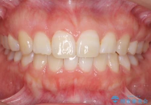 よくある悩み 前歯が裏に2本入っているのを治したいの症例 治療後
