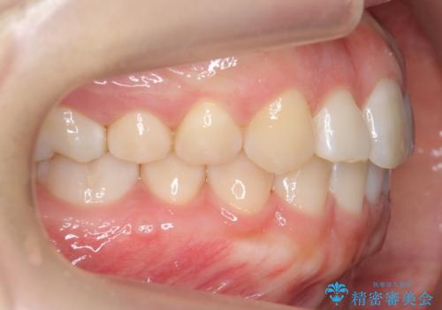 よくある悩み 前歯が裏に2本入っているのを治したいの治療後
