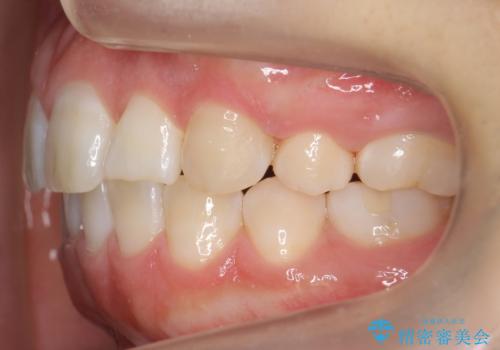 よくある悩み 前歯が裏に2本入っているのを治したいの治療後