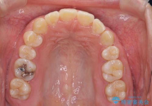 よくある悩み 前歯が裏に2本入っているのを治したいの治療後
