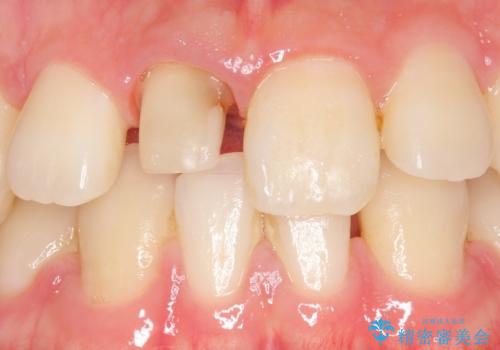 オールセラミッククラウン 変色した前歯の治療中