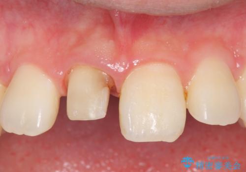 オールセラミッククラウン 変色した前歯の治療中