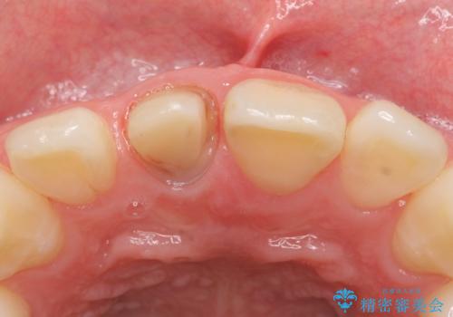 オールセラミッククラウン 変色した前歯の治療中