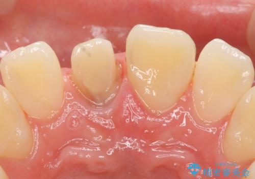 オールセラミッククラウン 変色した前歯の治療中