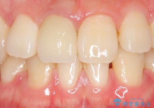オールセラミッククラウン 変色した前歯の治療後