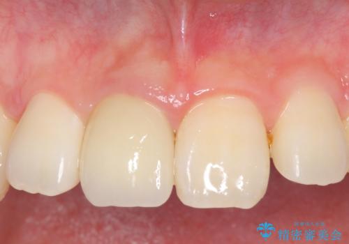 オールセラミッククラウン 変色した前歯の症例 治療後