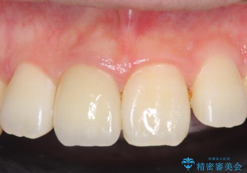 オールセラミッククラウン 変色した前歯の治療後