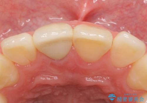オールセラミッククラウン 変色した前歯の治療後