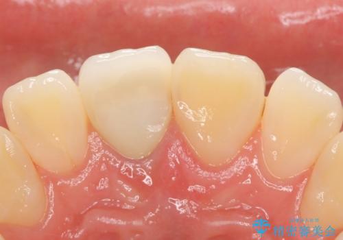 オールセラミッククラウン 変色した前歯の治療後