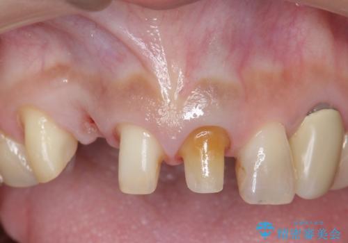 オールセラミッククラウン　下がってしまった前歯の歯茎の改善の治療中