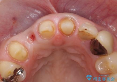 オールセラミッククラウン 下がってしまった前歯の歯茎の改善の治療中