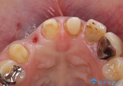 オールセラミッククラウン 下がってしまった前歯の歯茎の改善の治療中