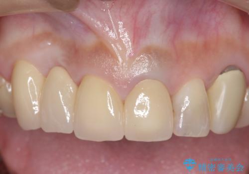 オールセラミッククラウン　下がってしまった前歯の歯茎の改善の症例 治療後