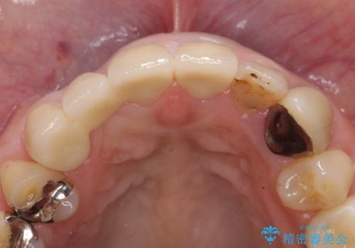 オールセラミッククラウン 下がってしまった前歯の歯茎の改善の治療後