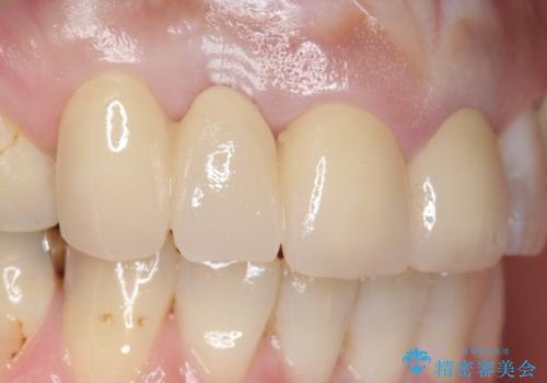 オールセラミッククラウン 下がってしまった前歯の歯茎の改善の治療後