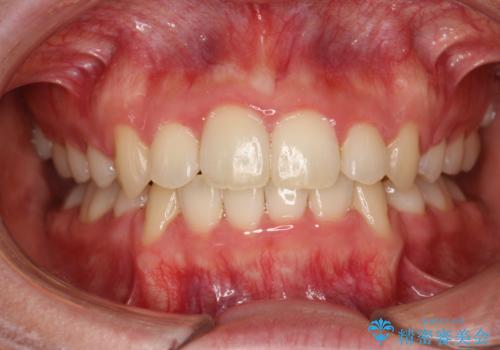全体的ながたつき　ワイヤーによる抜歯矯正で整った歯並びへの治療後