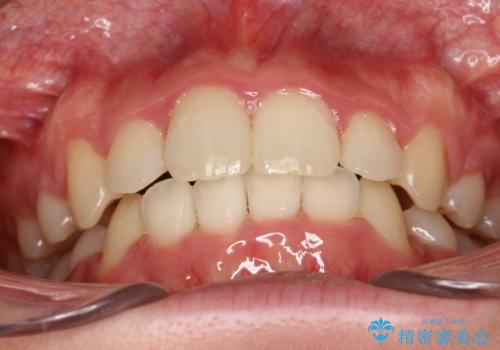 全体的ながたつき　ワイヤーによる抜歯矯正で整った歯並びへの治療後