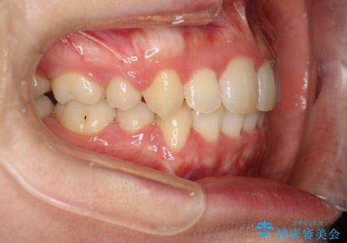 全体的ながたつき ワイヤーによる抜歯矯正で整った歯並びへの治療後