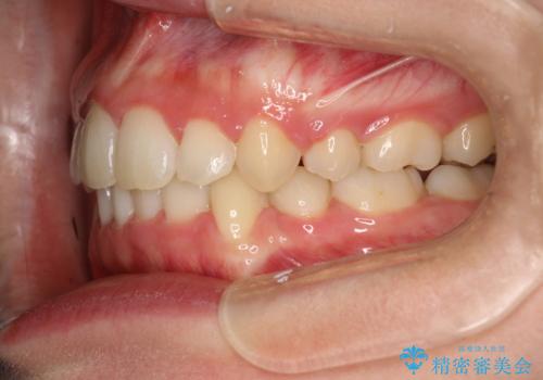 全体的ながたつき ワイヤーによる抜歯矯正で整った歯並びへの治療後