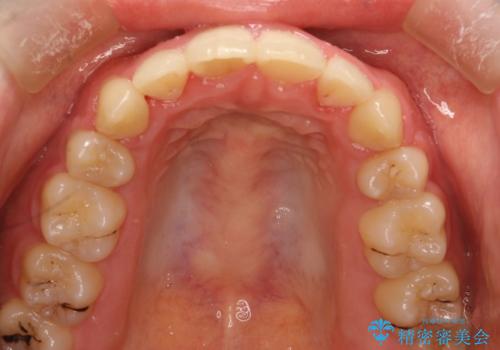 全体的ながたつき ワイヤーによる抜歯矯正で整った歯並びへの治療後