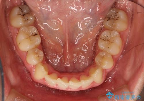 全体的ながたつき ワイヤーによる抜歯矯正で整った歯並びへの治療後
