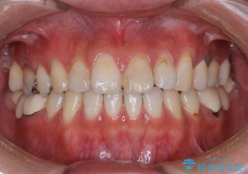 虫歯治療を始める前のPMTCの治療前