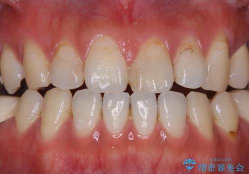 虫歯治療を始める前のPMTCの治療前