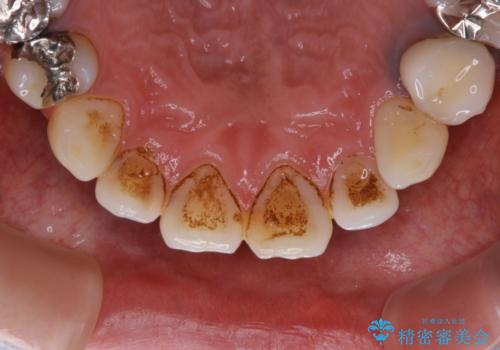 虫歯治療を始める前のPMTCの治療前