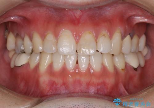 虫歯治療を始める前のPMTCの治療後