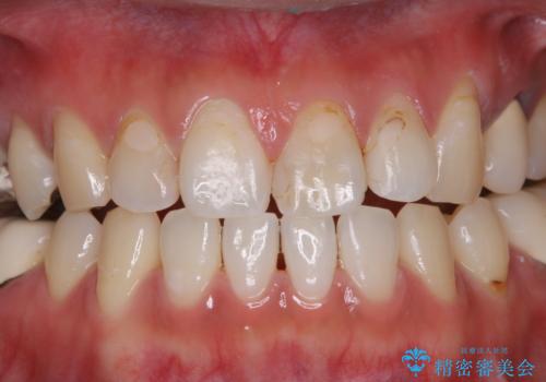 虫歯治療を始める前のPMTCの治療後