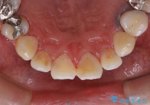 虫歯治療を始める前のPMTCの治療後