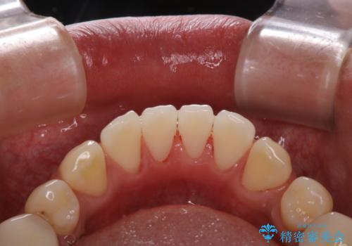 虫歯治療を始める前のPMTCの治療後