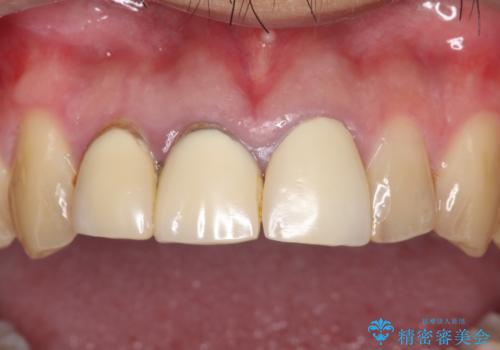 昔装着したかぶせ物を自然な色にしたい オールセラミックによる審美的改善の治療前