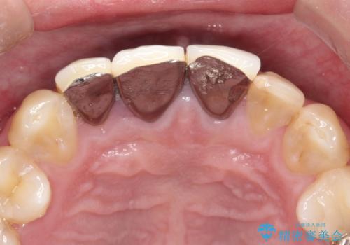 昔装着したかぶせ物を自然な色にしたい オールセラミックによる審美的改善の治療前