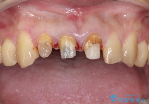 昔装着したかぶせ物を自然な色にしたい オールセラミックによる審美的改善の治療前