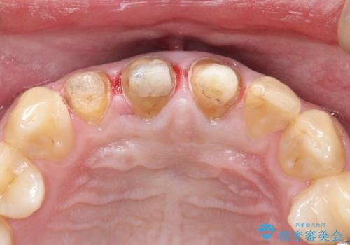 昔装着したかぶせ物を自然な色にしたい オールセラミックによる審美的改善の治療中