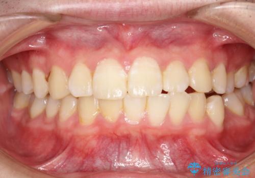 口臭予防にPMTCでお口のケアの治療前