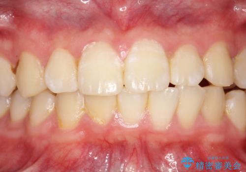 口臭予防にPMTCでお口のケア