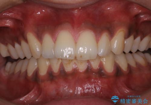 歯についたタバコのヤニをPMTCで綺麗にの治療前