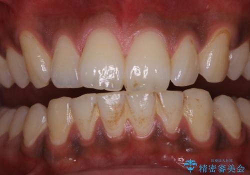歯についたタバコのヤニをPMTCで綺麗にの治療前