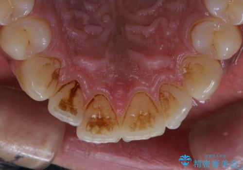 歯についたタバコのヤニをPMTCで綺麗にの治療前