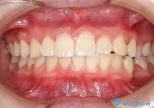 口臭予防にPMTCでお口のケアの治療後