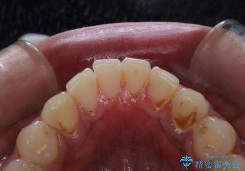 歯についたタバコのヤニをPMTCで綺麗にの治療前