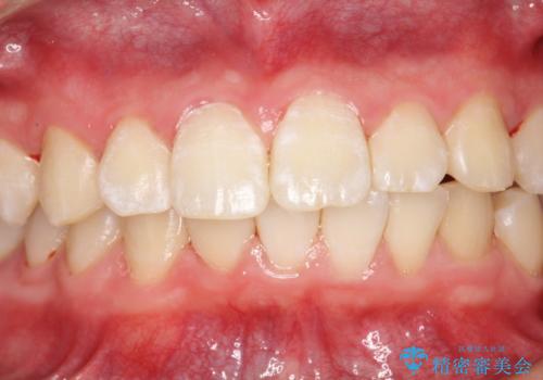 口臭予防にPMTCでお口のケアの治療後