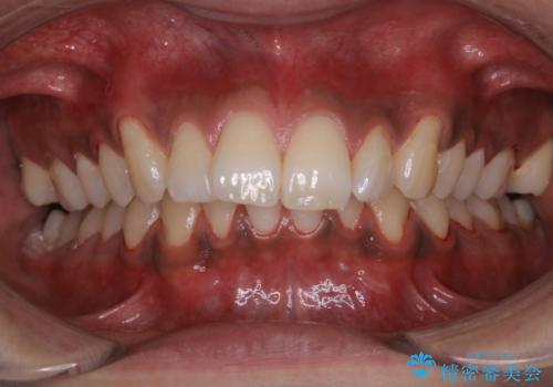 歯についたタバコのヤニをPMTCで綺麗にの治療後