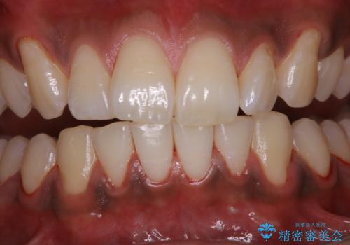 歯についたタバコのヤニをPMTCで綺麗にの治療後